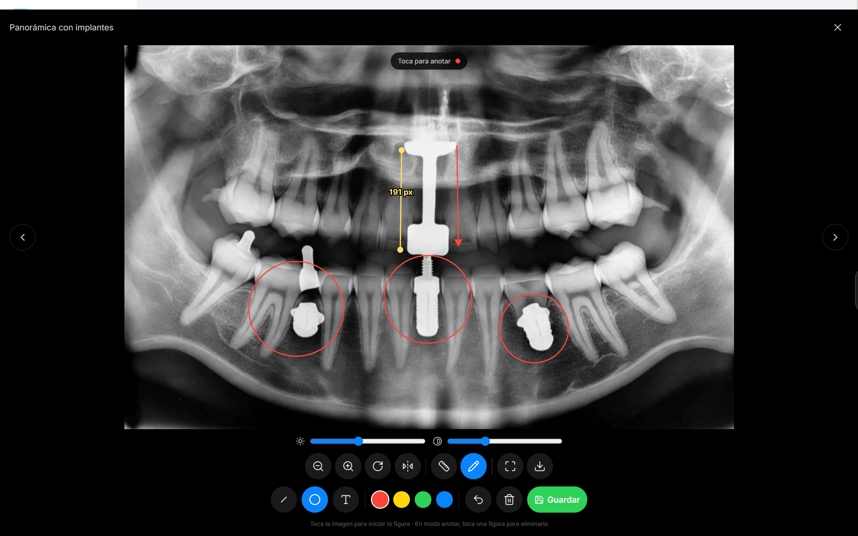 Mide pérdida ósea e implantes en milímetros reales. No a ojo.